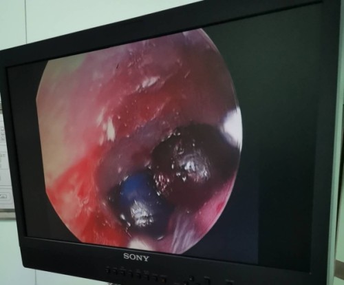 小朋友把异物放入耳朵,儿童把异物塞进耳朵