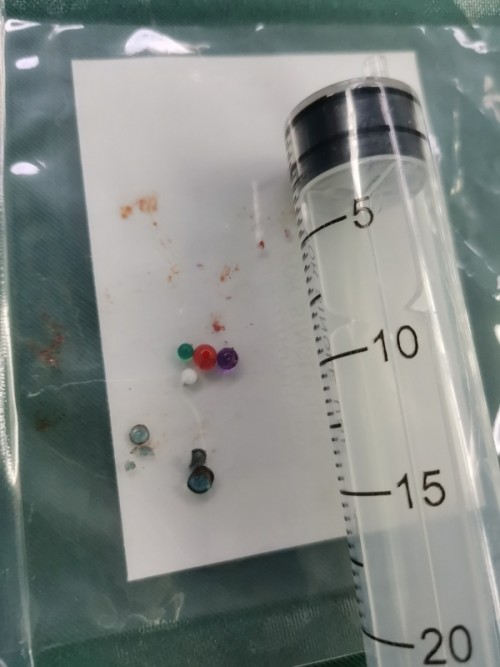 小朋友把异物放入耳朵,儿童把异物塞进耳朵