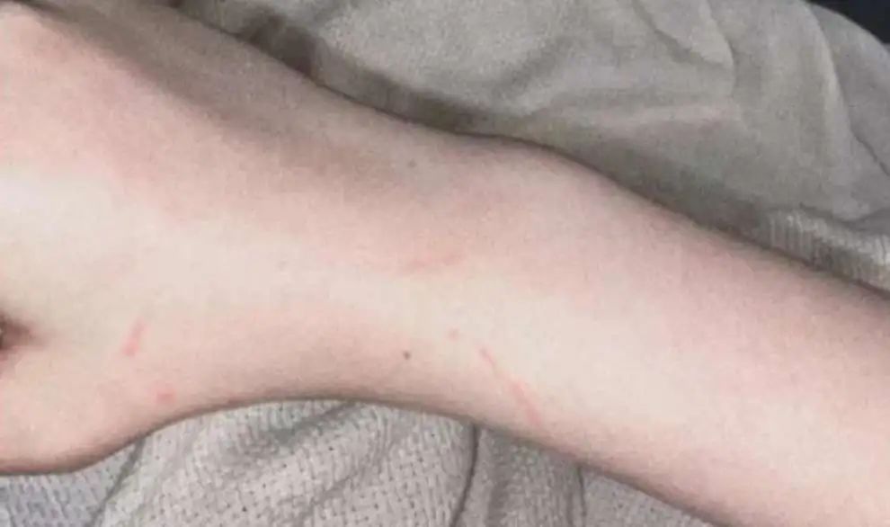 被流浪猫咬到没什么大事吧,不小心被猫咬了一口要打针么