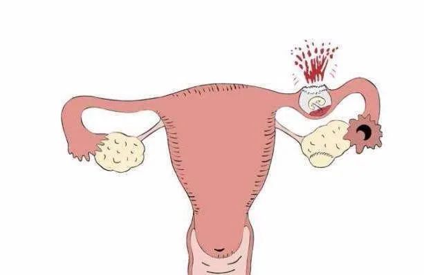 科普女性分娩危险,妇产疾病相关知识