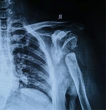 兰大二院骨科完成我省首例重度夏科氏关节-3D打印个性化定制-反肩关节置换手术