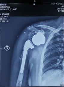 兰大二院骨科完成我省首例重度夏科氏关节-3D打印个性化定制-反肩关节置换手术