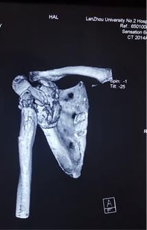 兰大二院骨科完成我省首例重度夏科氏关节-3D打印个性化定制-反肩关节置换手术