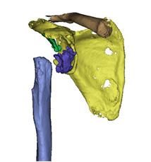 兰大二院骨科完成我省首例重度夏科氏关节-3D打印个性化定制-反肩关节置换手术
