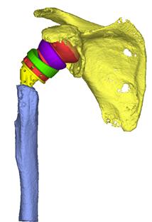 兰大二院骨科完成我省首例重度夏科氏关节-3D打印个性化定制-反肩关节置换手术