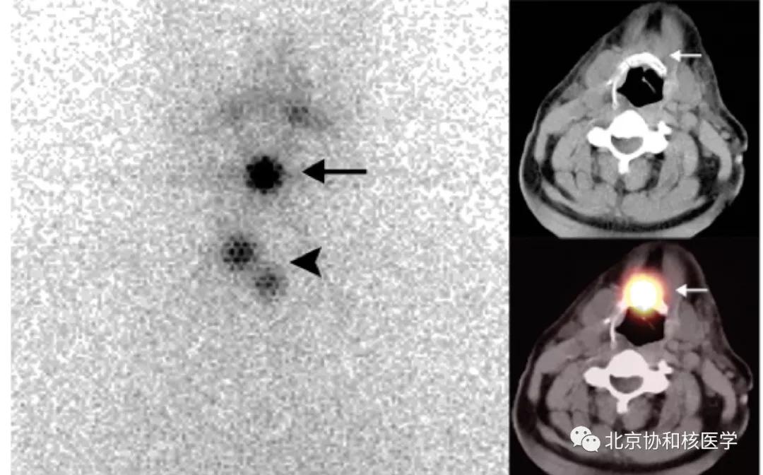 碘扫描最坏的结果,放射性核素扫描可以鉴别诊断吗