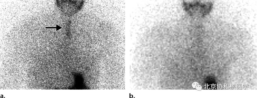 碘扫描最坏的结果,放射性核素扫描可以鉴别诊断吗