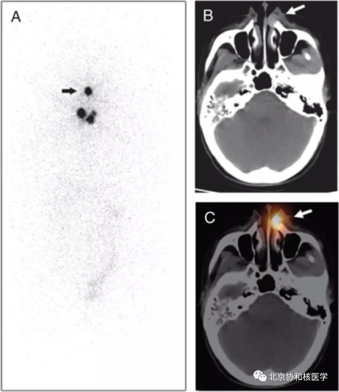 碘扫描最坏的结果,放射性核素扫描可以鉴别诊断吗