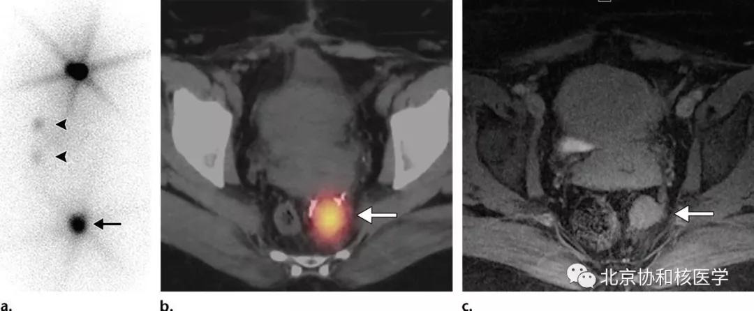 碘扫描最坏的结果,放射性核素扫描可以鉴别诊断吗