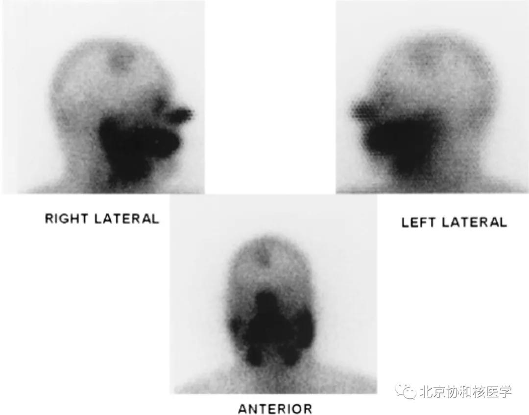 碘扫描最坏的结果,放射性核素扫描可以鉴别诊断吗