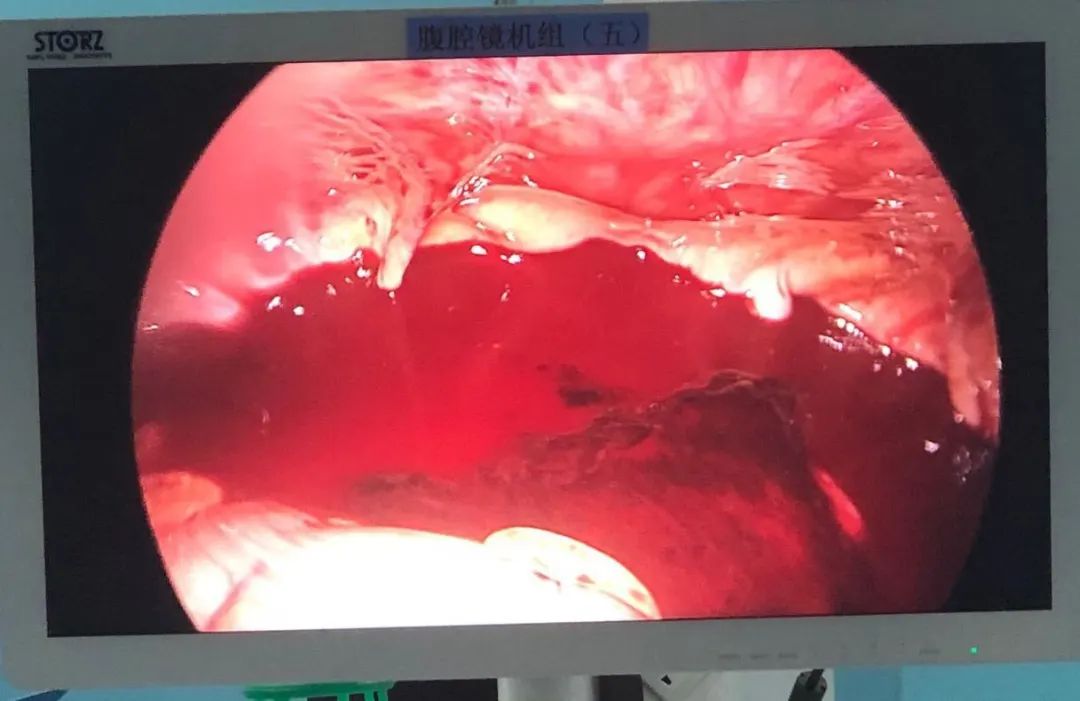 同房后“血崩”,90后姑娘差点丢了命!这个危险因素,你需要了解……