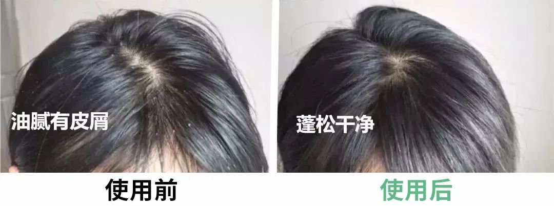 7天挑战无头屑,挑战5天不洗头依旧蓬松不油头