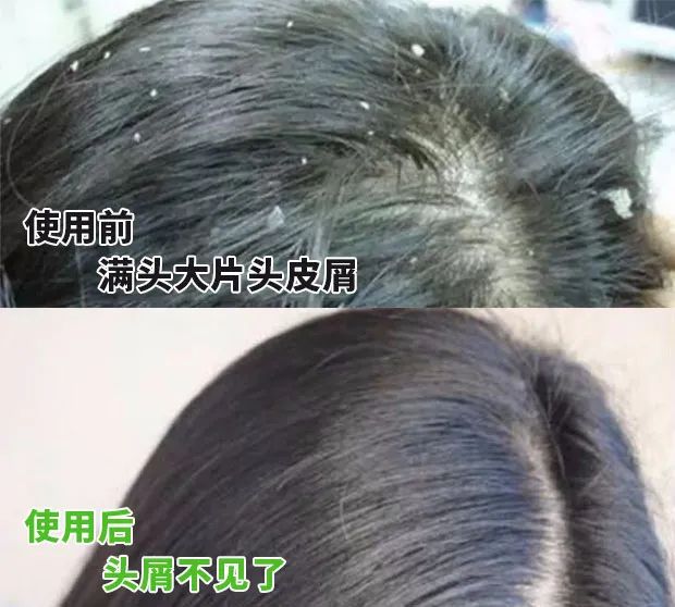 7天挑战无头屑,挑战5天不洗头依旧蓬松不油头