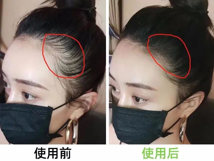 7天挑战无头屑,挑战5天不洗头依旧蓬松不油头