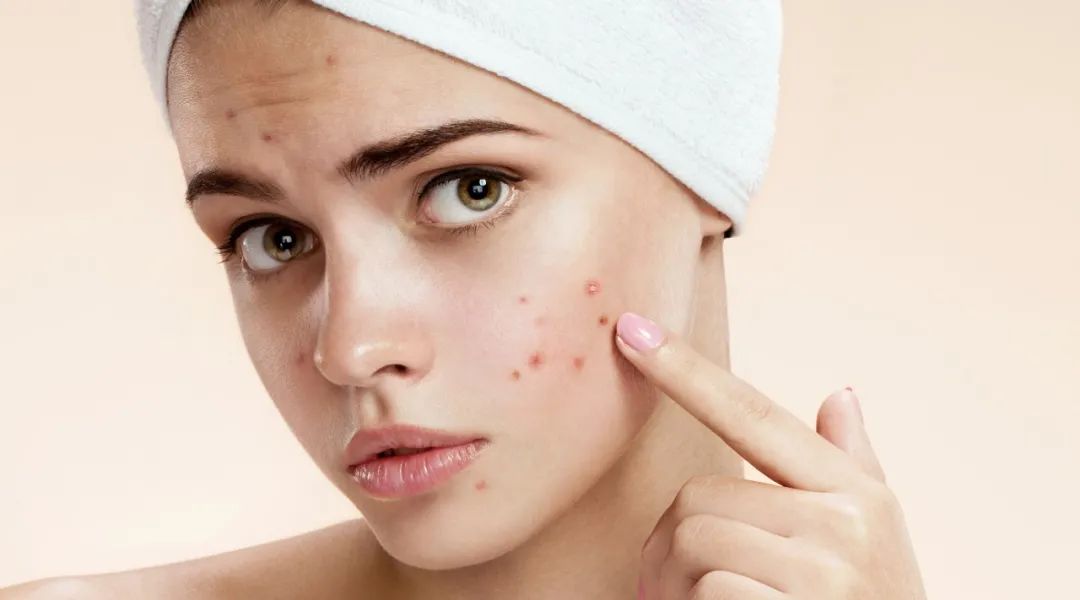 想要消痘痘不能吃什么,爆痘怎么快速消下去不留印子