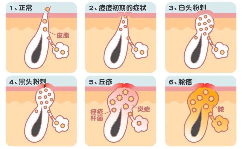 想要消痘痘不能吃什么,爆痘怎么快速消下去不留印子