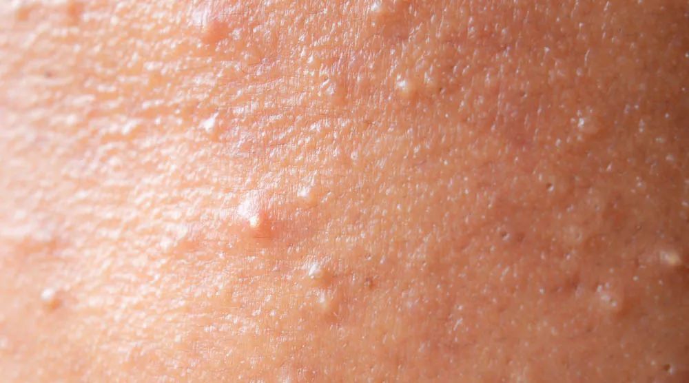 想要消痘痘不能吃什么,爆痘怎么快速消下去不留印子