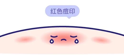 想要消痘痘不能吃什么,爆痘怎么快速消下去不留印子