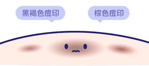 想要消痘痘不能吃什么,爆痘怎么快速消下去不留印子