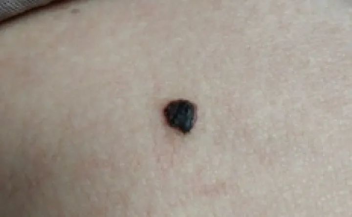 黑痣癌变的痣会很大吗,黑痣癌变一般是一个痣还是好多