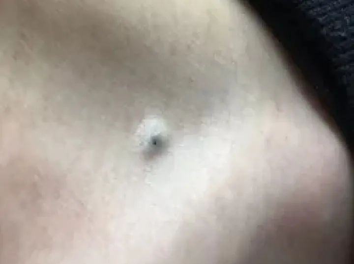 黑痣癌变的痣会很大吗,黑痣癌变一般是一个痣还是好多