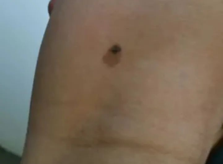 黑痣癌变的痣会很大吗,黑痣癌变一般是一个痣还是好多