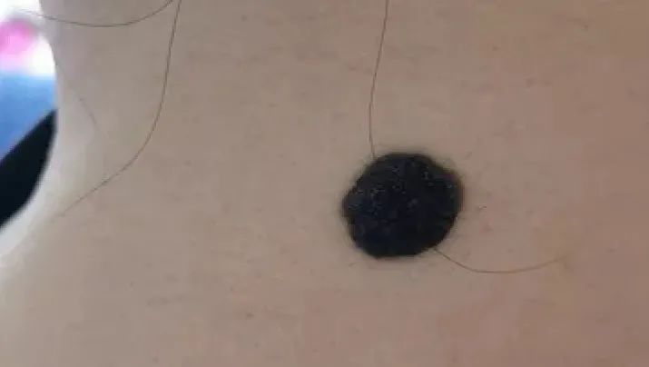 黑痣癌变的痣会很大吗,黑痣癌变一般是一个痣还是好多