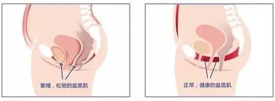 盆底肌又称爱情肌,盆底肌向前