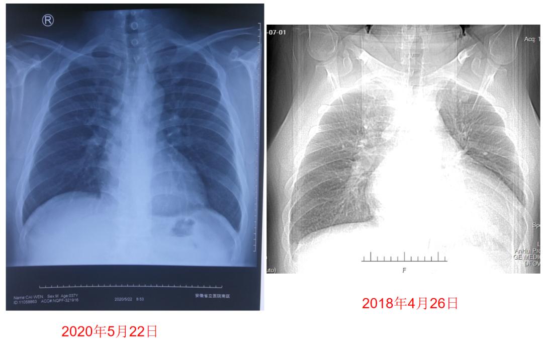 专家讲解arni药治疗心衰病例,抗心衰药物arni