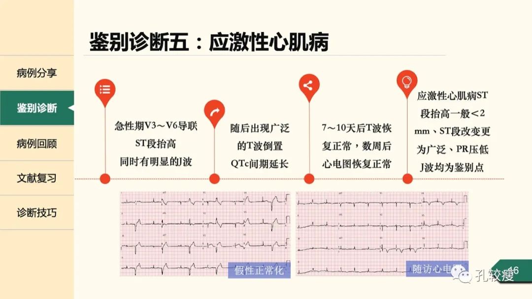 t波倒置在心电图中怎么看,T波低平心电图讲解