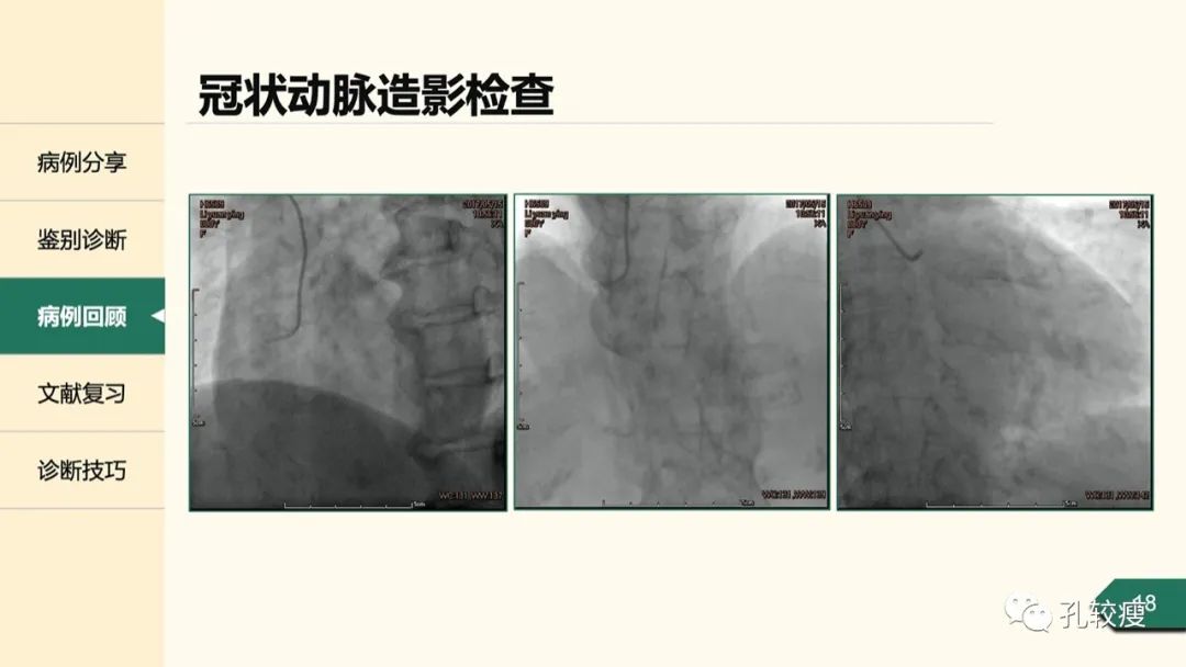 t波倒置在心电图中怎么看,T波低平心电图讲解