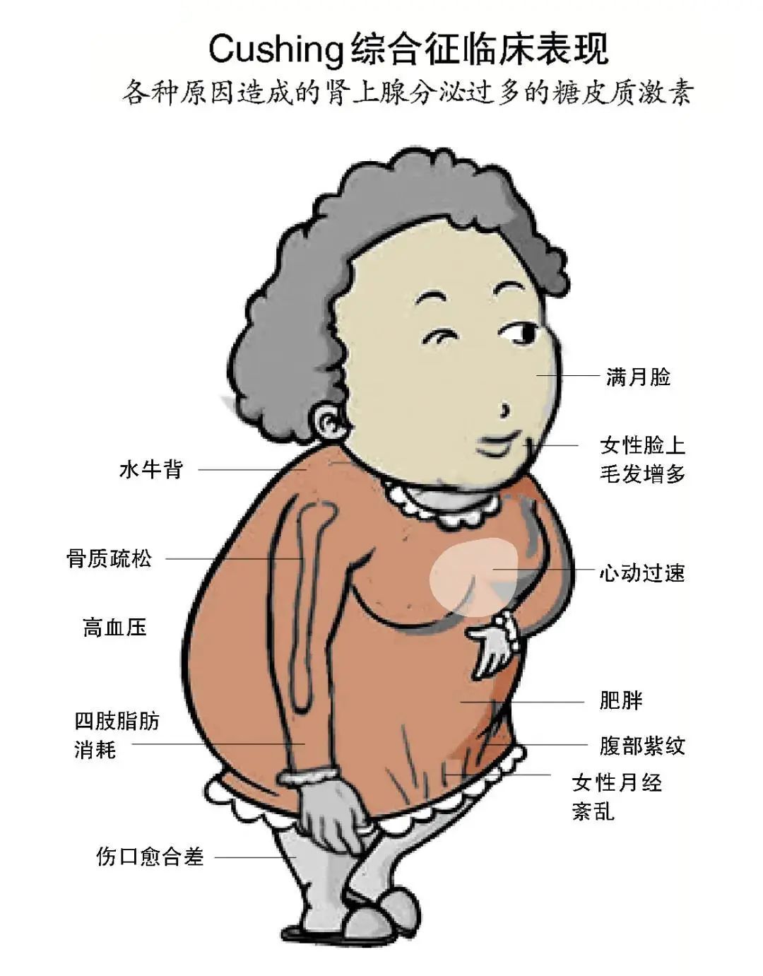 突然变胖了是肺癌吗,女性突然变胖是不是身体有问题