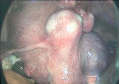 中年女士肚子大的跟怀孕一样,五岁小姑娘肚子突然变大了