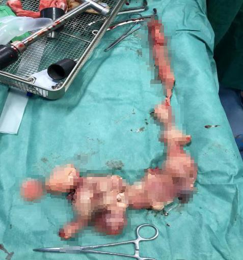 中年女士肚子大的跟怀孕一样,五岁小姑娘肚子突然变大了