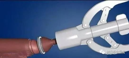 【干货】@家长,小孩包皮长这样该切,治疗的黄金时期是……