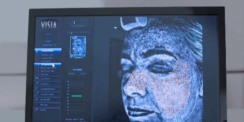 花了3万做激光，才彻底懂了：医生为什么劝你别去斑