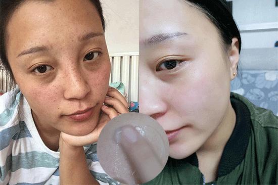 花了3万做激光，才彻底懂了：医生为什么劝你别去斑