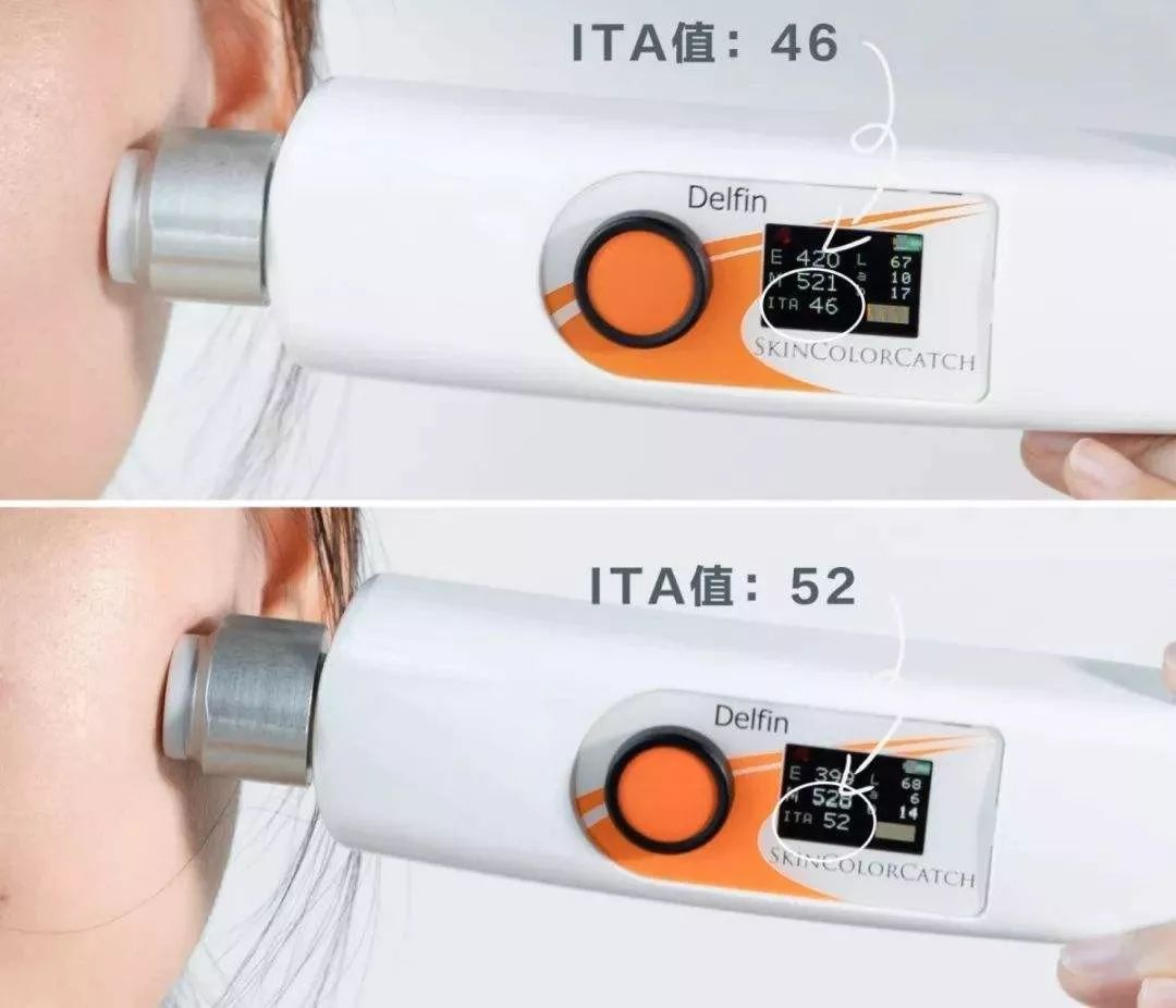 花了3万做激光，才彻底懂了：医生为什么劝你别去斑