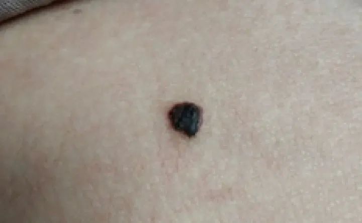 黑痣癌变的10个征兆,黑痣癌变从发病到去世不到两个月