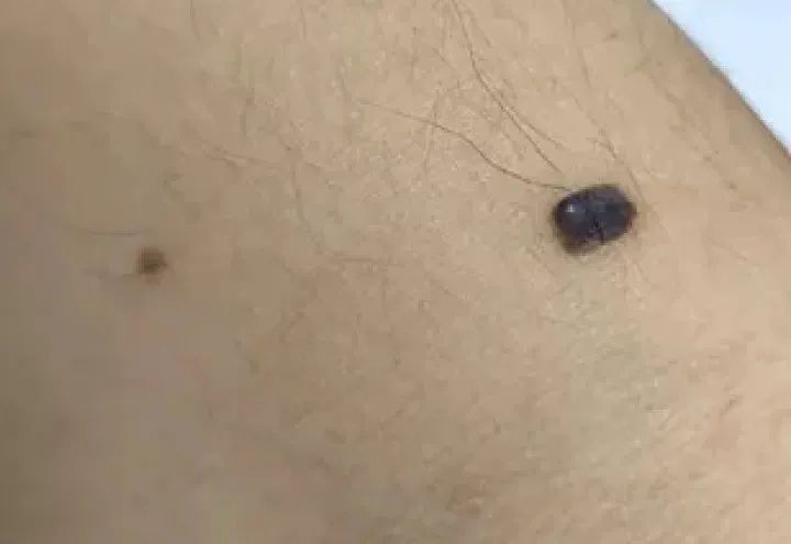 黑痣癌变的10个征兆,黑痣癌变从发病到去世不到两个月