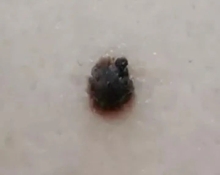 黑痣癌变的10个征兆,黑痣癌变从发病到去世不到两个月