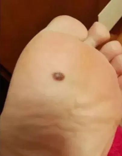 黑痣癌变的10个征兆,黑痣癌变从发病到去世不到两个月