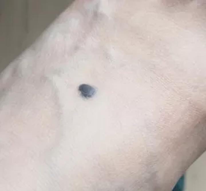 黑痣癌变的10个征兆,黑痣癌变从发病到去世不到两个月