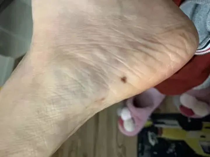 黑痣癌变的10个征兆,黑痣癌变从发病到去世不到两个月