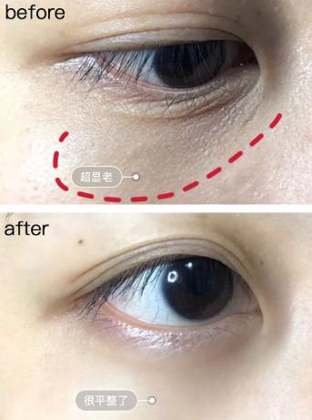 马应龙痔疮膏救了好多人,马应龙痔疮膏黑眼圈亲身体验