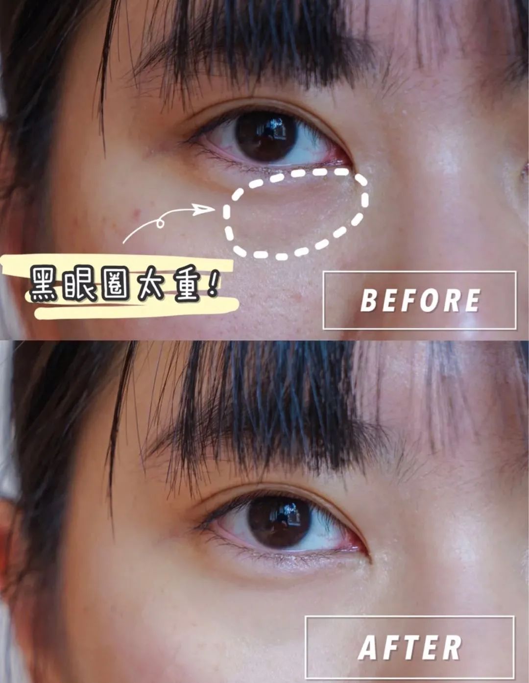 马应龙痔疮膏救了好多人,马应龙痔疮膏黑眼圈亲身体验