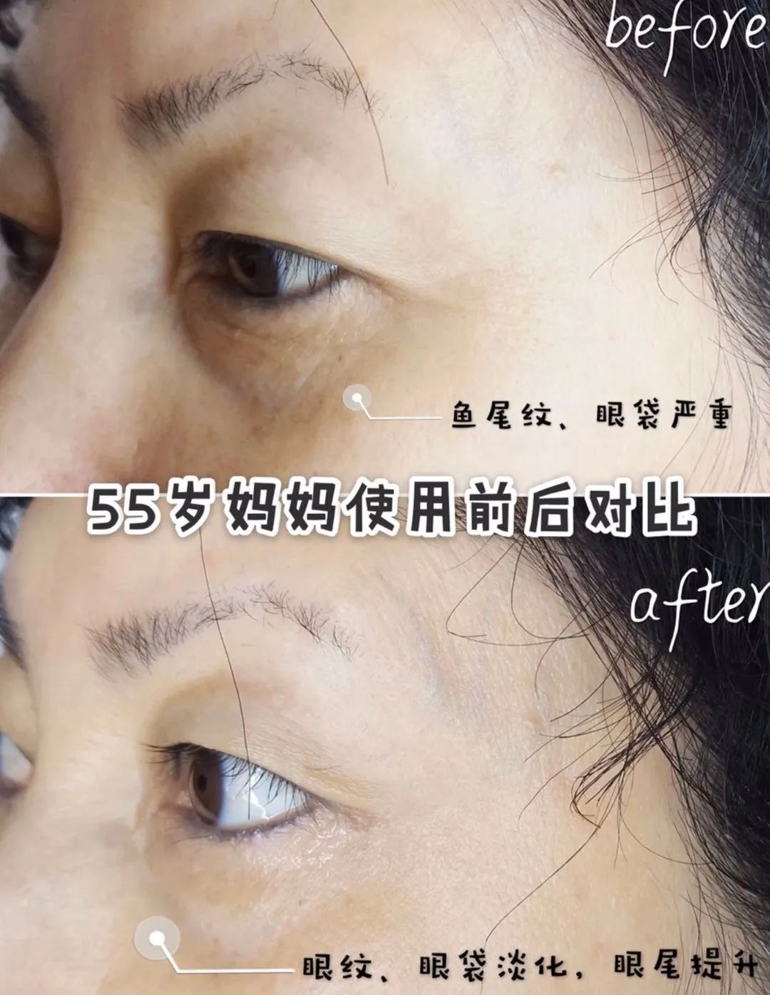 马应龙痔疮膏救了好多人,马应龙痔疮膏黑眼圈亲身体验