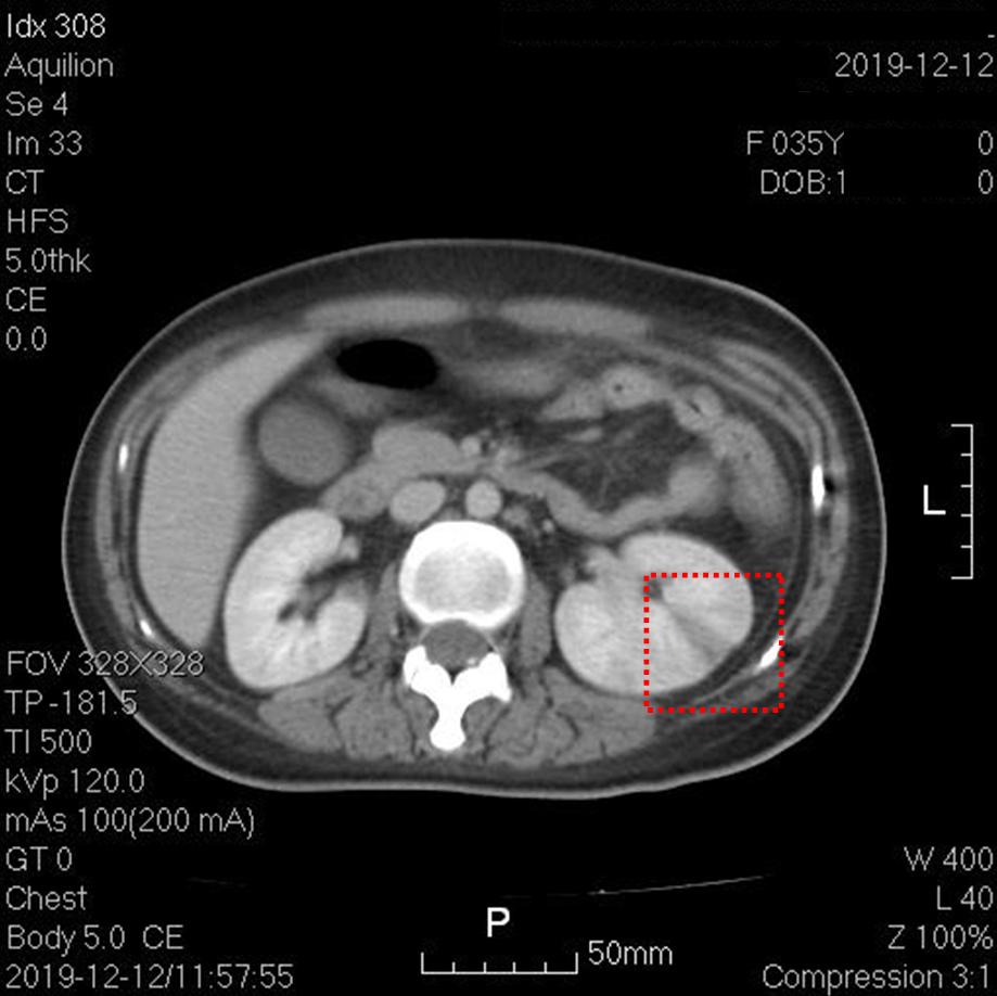 快看!心脏“漏了个洞”,人竟然还活着……
