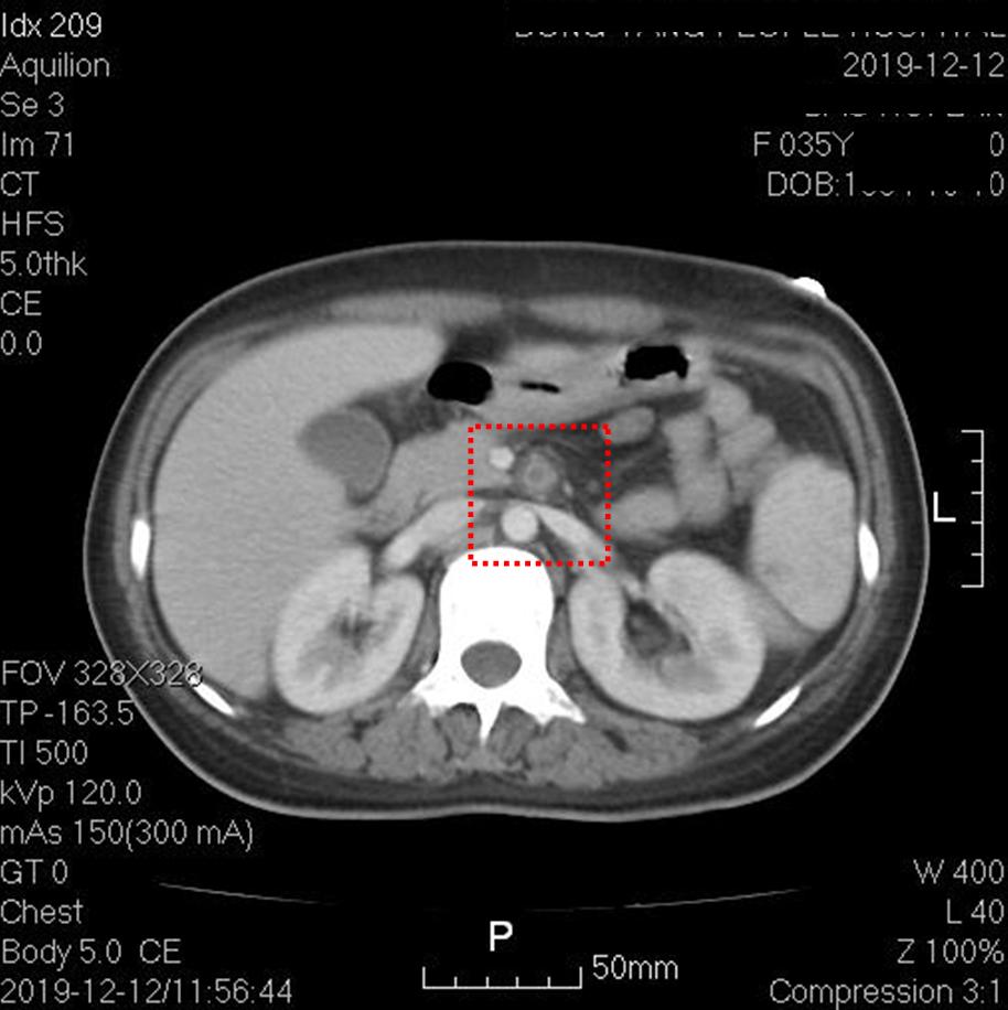 快看!心脏“漏了个洞”,人竟然还活着……