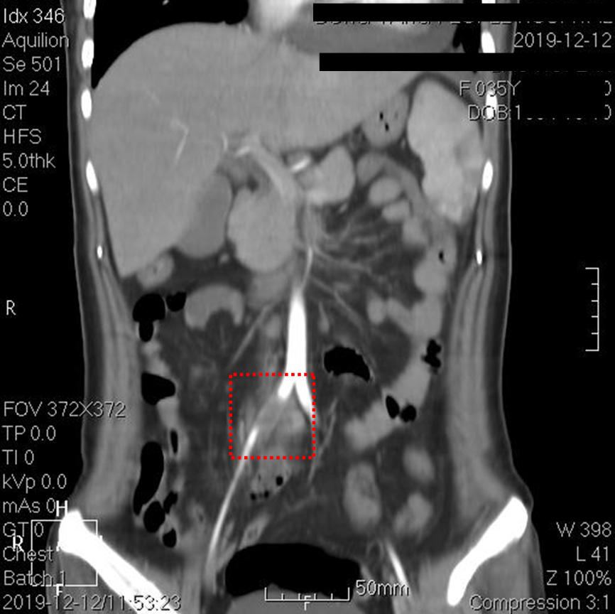 快看!心脏“漏了个洞”,人竟然还活着……